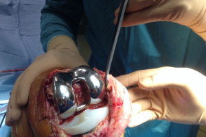 Teaching omtrent totale knieprothese